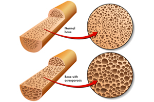 Osteoporosis