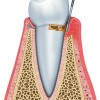 Initial Periodontitis