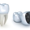 Dental Crowns