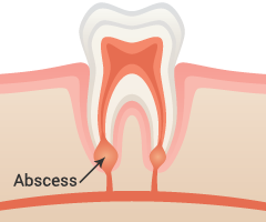 Abscess Removal