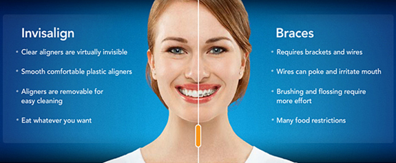 Invisalign® vs. Braces