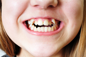 Young girl with malocclusion